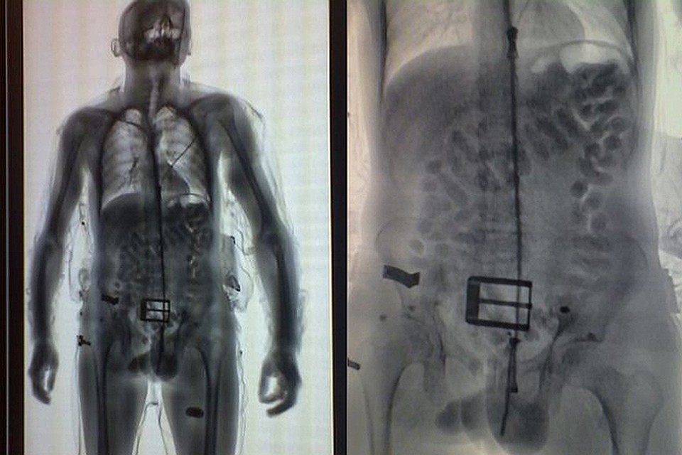Два рентгеновских снимка, и уже не нужно чистосердечное признание – отчетливо видно небольшие свертки в желудке.