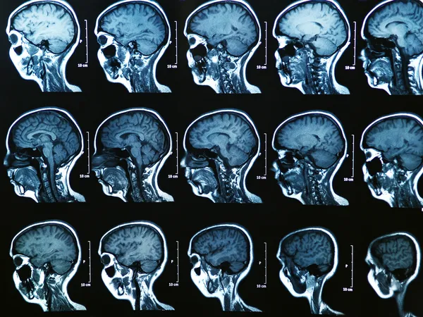 МРТ головного мозга — стоковое фото