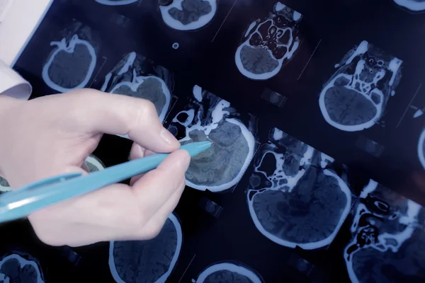 Крупным планом доктор руку, указывая на мозг Ct — стоковое фото