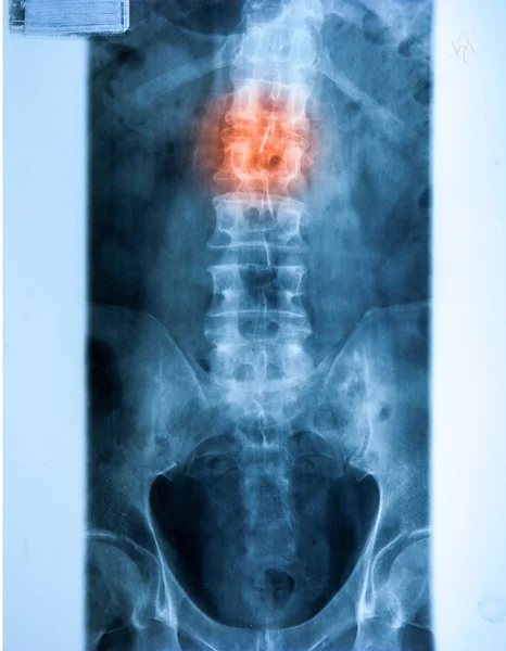 X-Рэй МРТ - изображение позвоночника шейные боли — стоковое фото