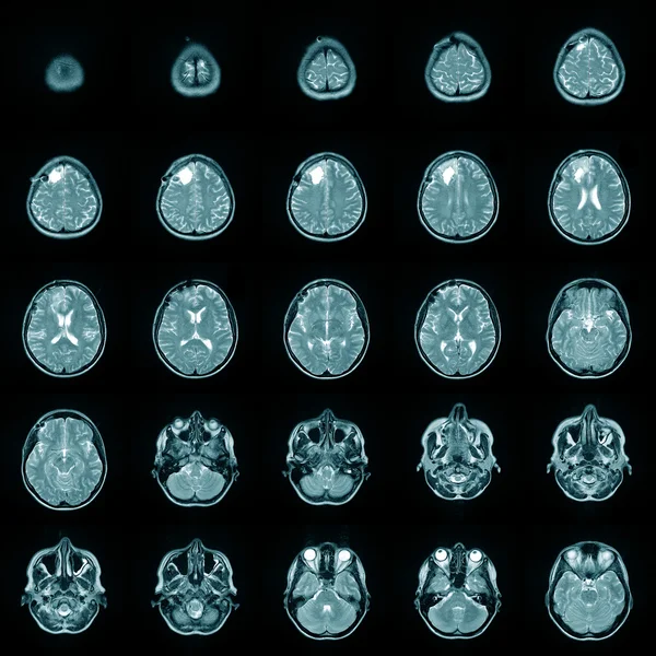 Магнитные risonance изображения МРТ головного мозга — стоковое фото