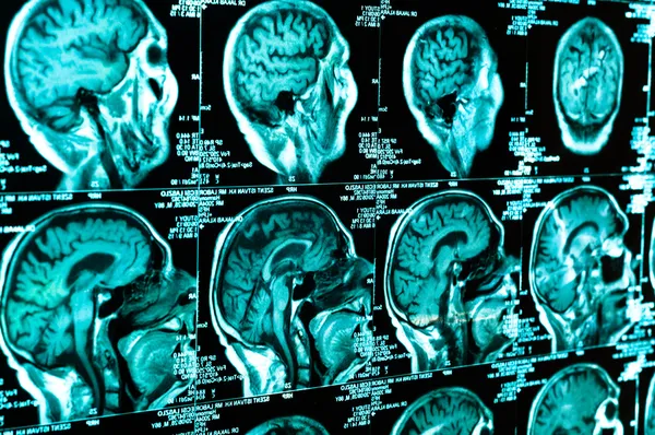 КТ сканирование мозга человека плитки — стоковое фото