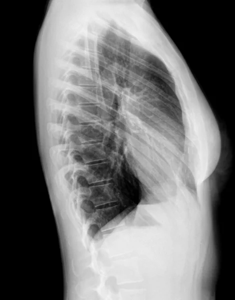 Рентген позвоночника - вид сбоку — стоковое фото