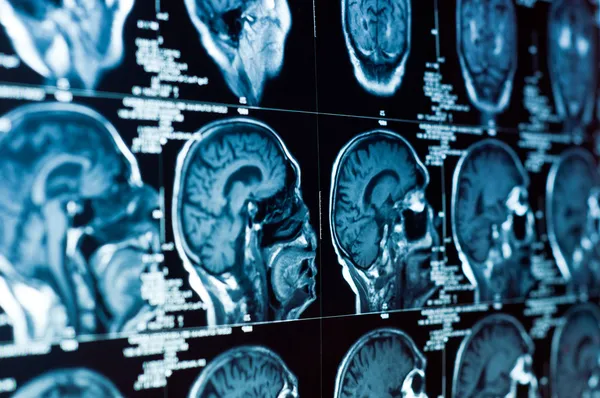 Крупным планом КТ головного мозга и черепа на нем — стоковое фото